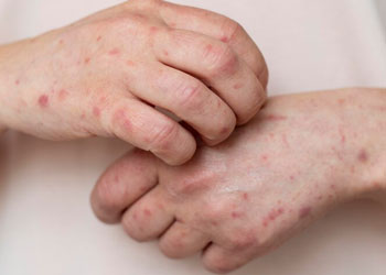 Leprosy Treatment Clinic in Kothapet